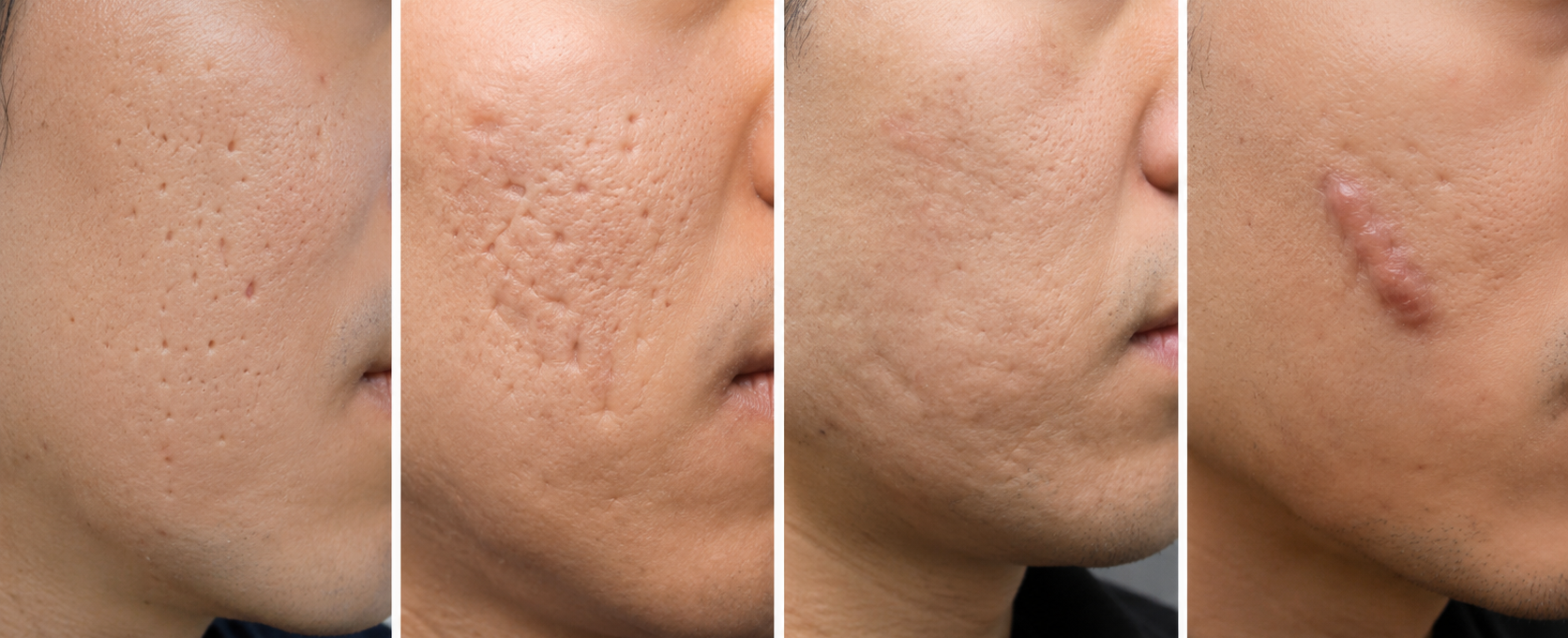 Songdo Human Dermatology_how enlarged pores develop