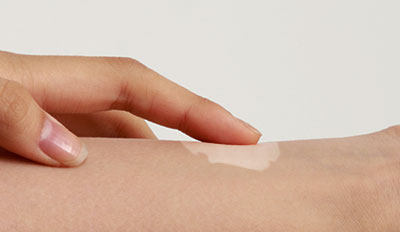 Vitiligo Treatment in Songdo, Incheon | Songdo Human Dermatology